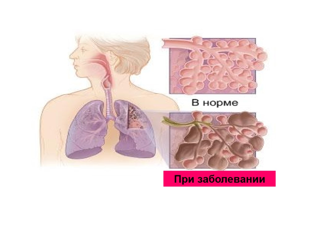 При заболевании